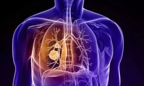浸润性肺腺癌生存几年